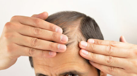 Top 4 reasons for unnatural hair loss patterns